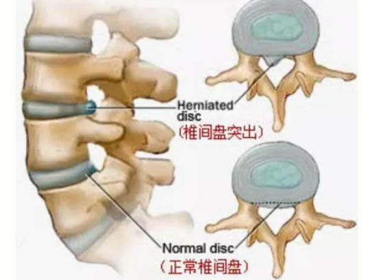 無菌性炎癥致痛學(xué)說與頸肩腰腿痛的發(fā)病機(jī)制