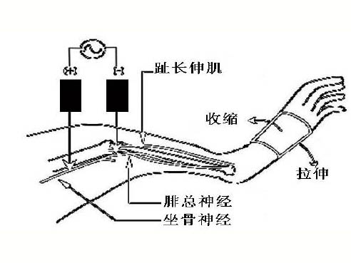 肌肉延遲性酸痛的機(jī)制研究進(jìn)展